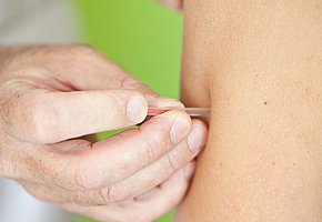 Eine männliche Hand platziert eine Akupunkturnadel im Oberarm einer Patientin.